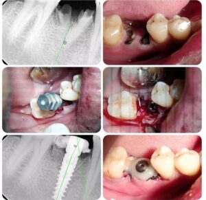 dental implant