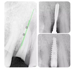 dentalimplant3