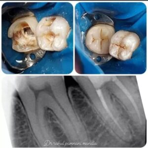 rootcanal2